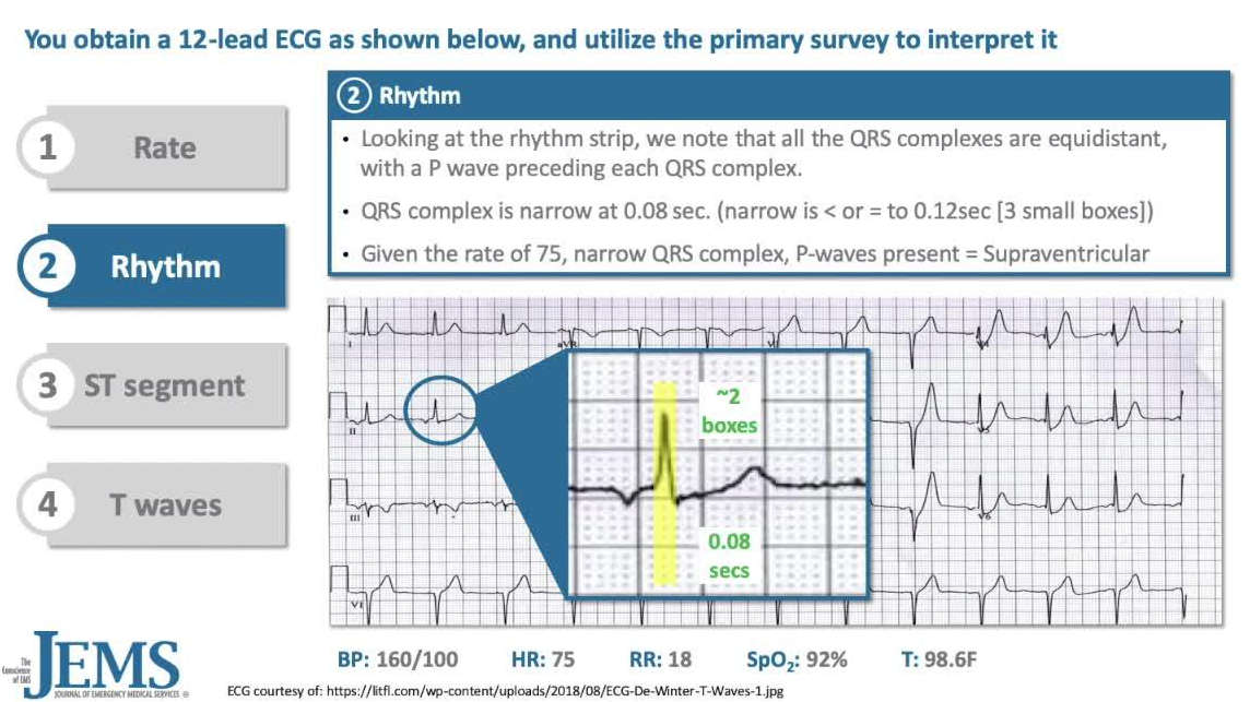 ECG Consult 46yo Male Banker With Sudden Onset Left Sided Chest Pain