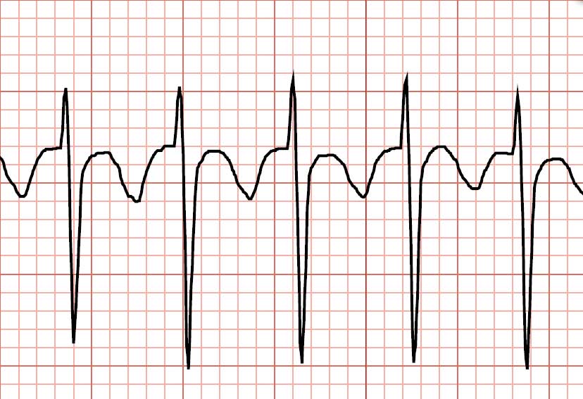 Assessing and Managing Pediatric Cardiac Rhythm Disturbances - JEMS ...