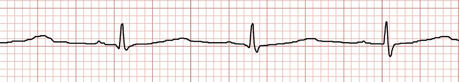 Assessing and Managing Pediatric Cardiac Rhythm Disturbances - JEMS ...