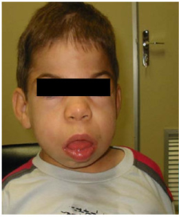 Pediatric Airway Presents Unique Challenges in Airway Management - JEMS ...