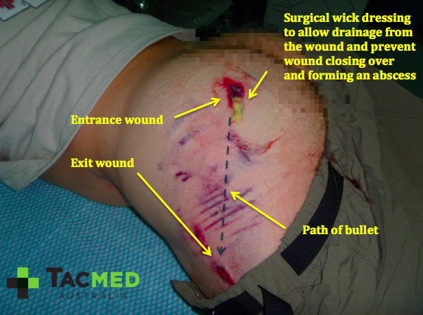 bullet wound treatment